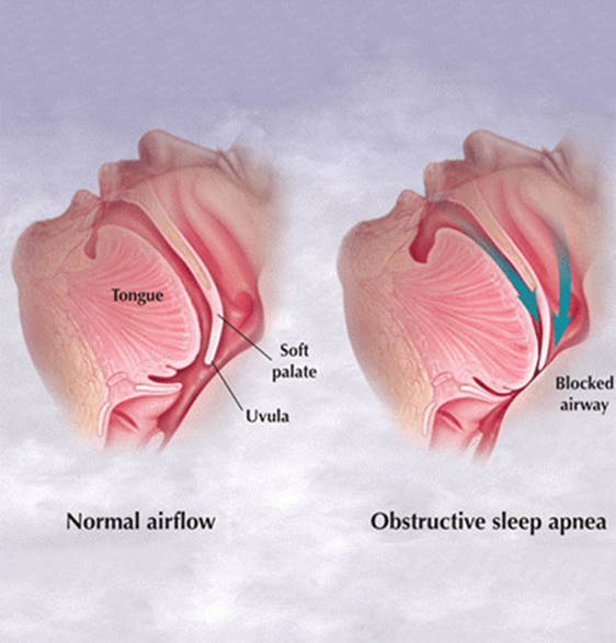 Obstructive Sleep Apnea osa Obstructive Sleep Apnea osa